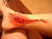 I Think I Need A Band Aid