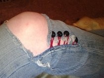 Hole In The Knee
