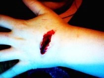 Deep Wound/Cut/Scratch