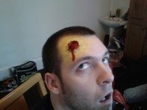 Bullet Wound